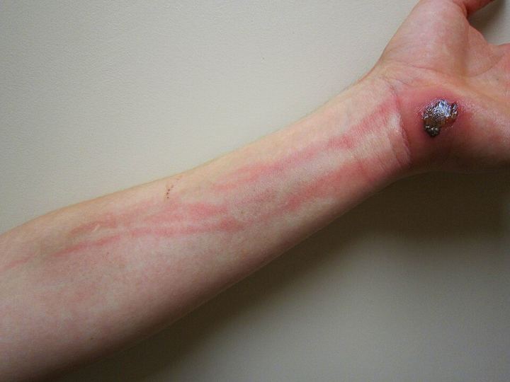 Cellulitis: red streaks spreading up the forearm from a graze at the wrist