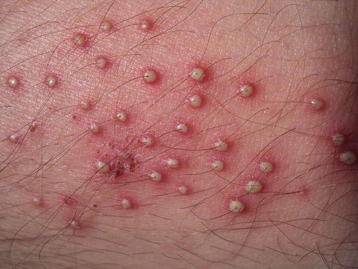 Folliculitis on a leg: small white-headed bumps around hair follicles