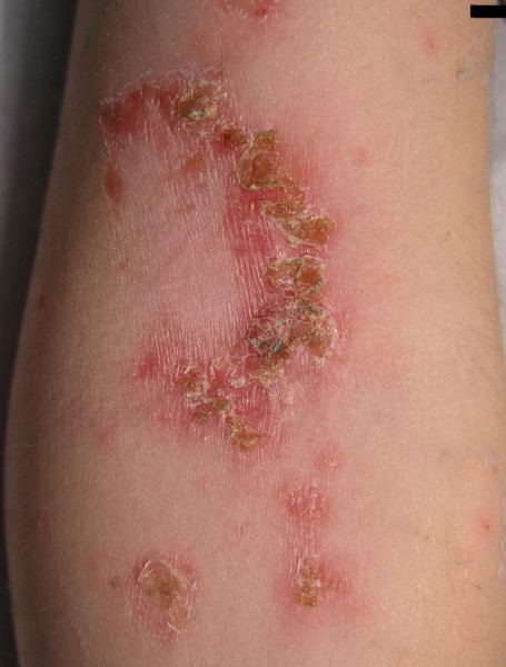 Impetigo on an elbow: red sores with honey-coloured crusts