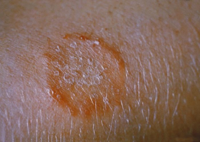 Ringworm on an arm: a round, red, scaly ring with clearer skin in the middle