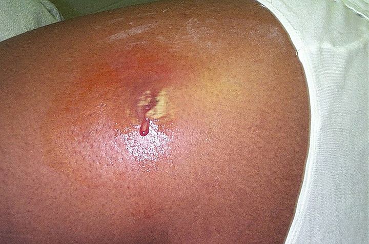 A red, swollen staph abscess on the skin with a small drainage point